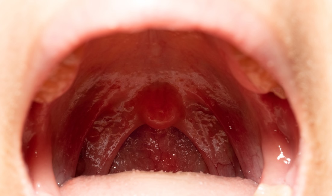 Uvule gonflée : comment faire pour la traiter ?